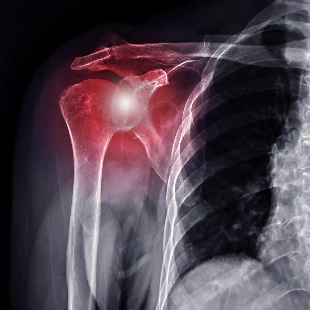 capsulite rétractile